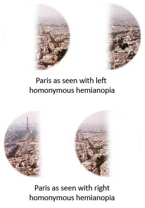 Homonymous Hemianopia
